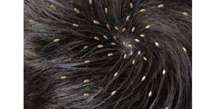 Does Hair Dye Kill Lice